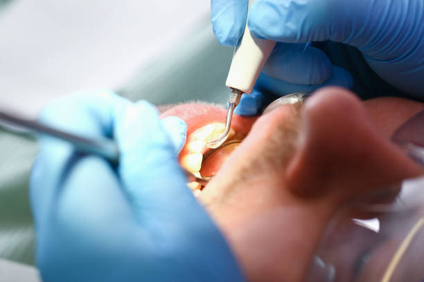 Best Emergency Dentist for Lost Fillings or Crowns in Willis, TX